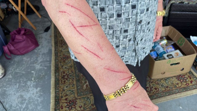 Venice man attacked in his neighborhood, deputies searching for suspect: ‘I was shocked’