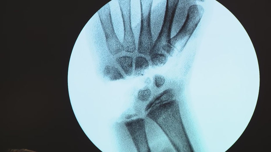 X-ray of Leah Lendel's hand.