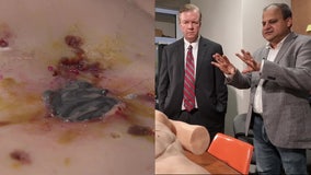 Breakthrough in science: UCF chemists develop life-saving wound sealant