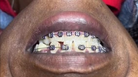 Dentists warn about dangers of illegal ‘veneer tech’ trend