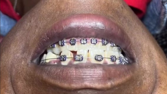 Dentists warn about dangers of illegal ‘veneer tech’ trend