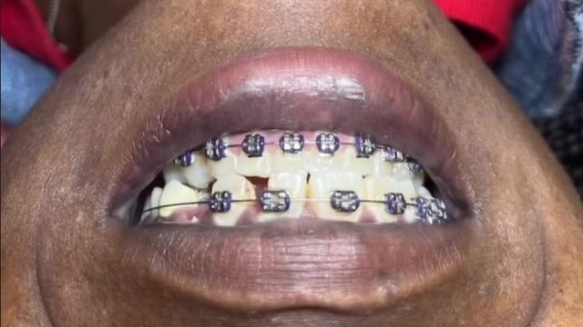 Dentists warn about dangers of illegal ‘veneer tech’ trend