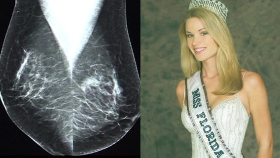 Two-time breast cancer survivor, former Miss Florida USA advocates for cancer patients