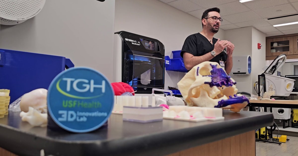 3D printed organs helping TGH doctors better prepare for difficult surgeries