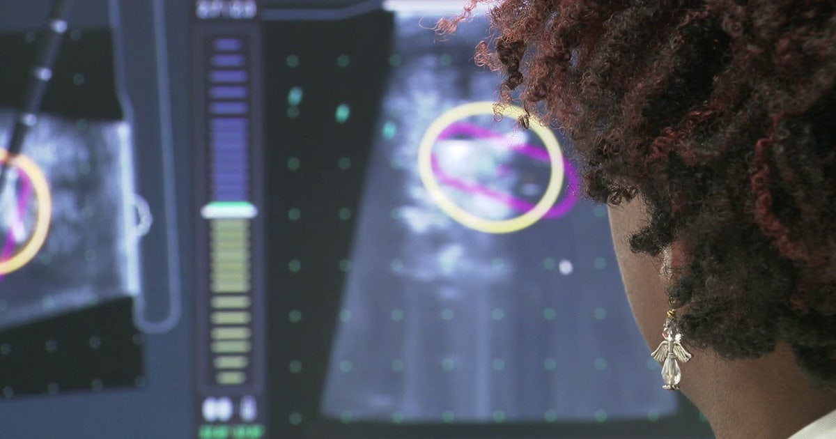 State law creating uterine fibroid research database not implemented 4 years later – what 1 lawmaker is doing