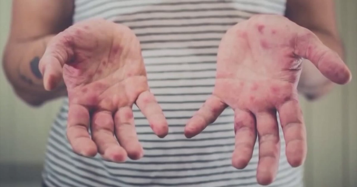 Florida measles cases: Doctors explain what it means for the community after confirming St. Pete case