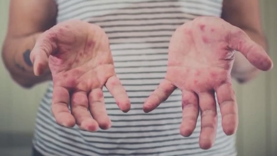 Florida measles cases: Doctors explain what it means for the community after confirming St. Pete case