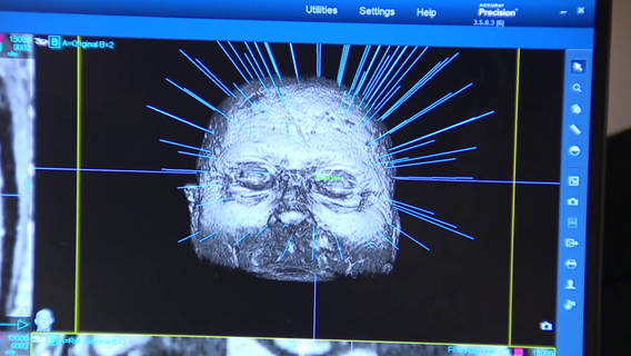 After years of tremors, one Tampa man gets his life back- no surgery required