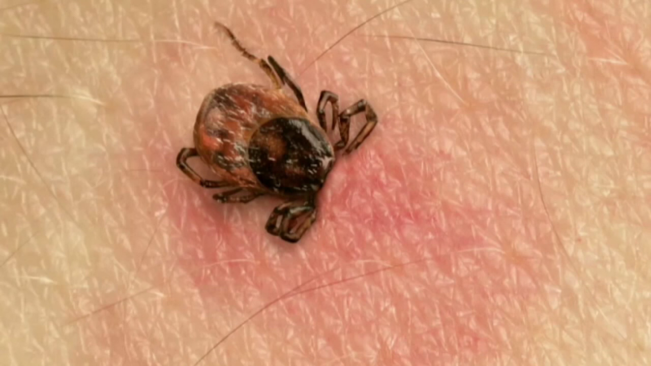 CDC reports record high ER visits for tick bites: What Bay Area doctors say you need to watch for this summer