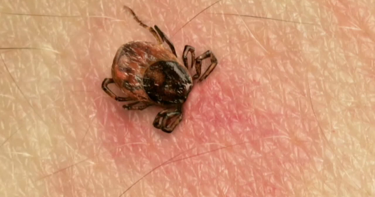 CDC reports record high ER visits for tick bites: What Bay Area doctors say you need to watch for this summer