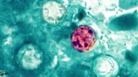 Florida Cyclosporiasis cases rise to 460: Here’s a county-by-county breakdown