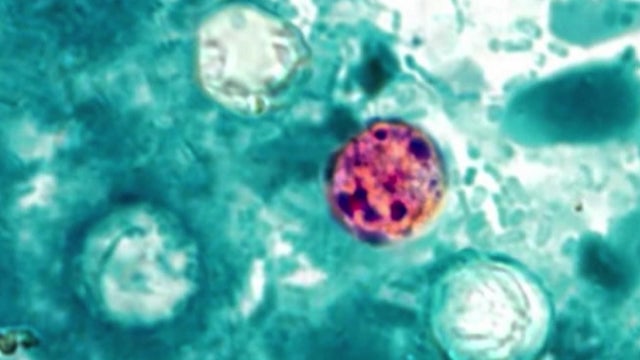 Florida Cyclosporiasis cases rise to 460: Here’s a county-by-county breakdown
