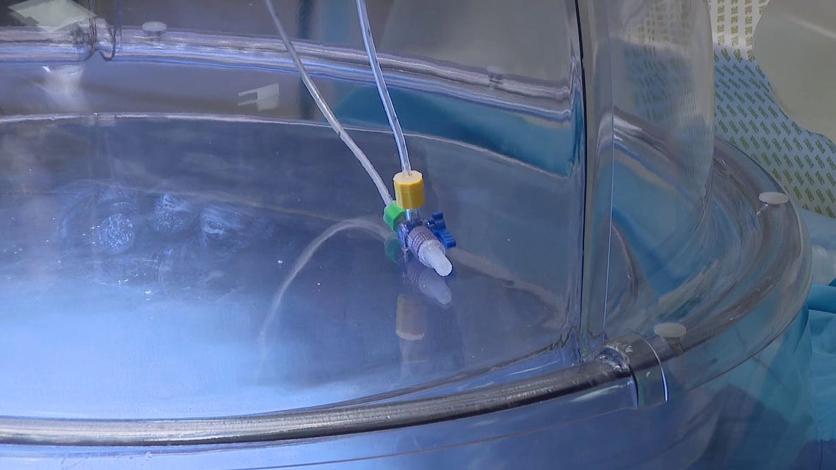 Tampa General lung transplants: New technology tests donor organ performance