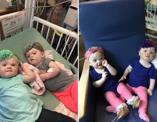 Formerly conjoined twins thriving months after separation surgery | FOX 26  Houston