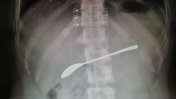 Drunk woman swallowed 6-inch spoon and forgot, report says