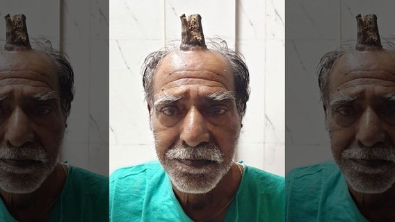 Man has 4-inch 'devil horn' removed from head