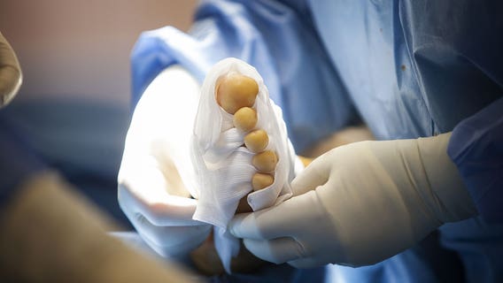 ‘Human error' during surgery results in girl losing thumb, having it replaced with her big toe