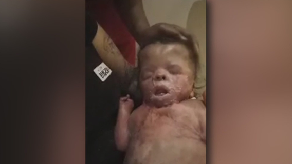 Ja'bari Gray, baby born with no skin, getting ready to go home