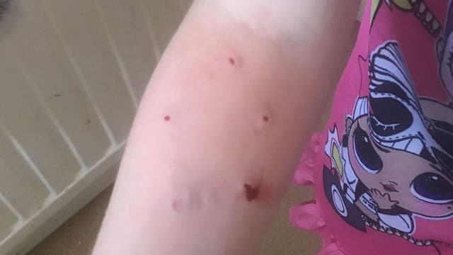 Gruesome cat bite infection sends girl, 6, to operating table