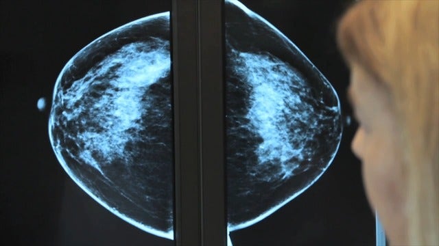 What are the symptoms of breast cancer?
