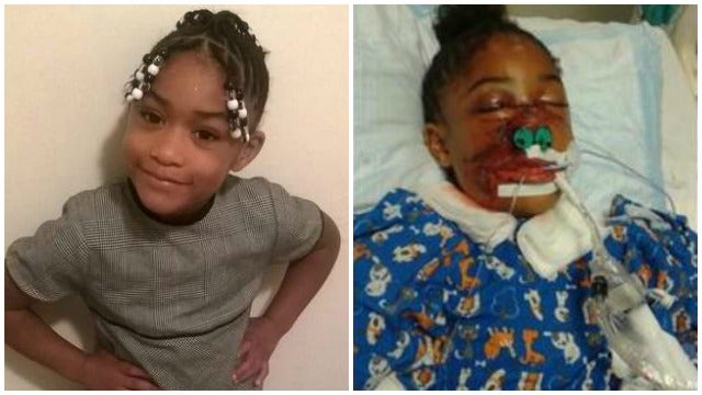 Child recovering after pitbull attack
