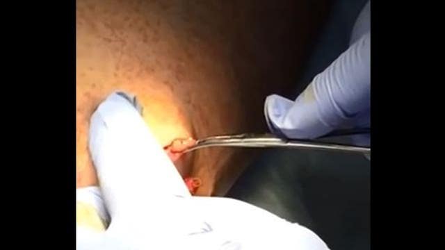 Pesky botfly removal is not for the sqeamish
