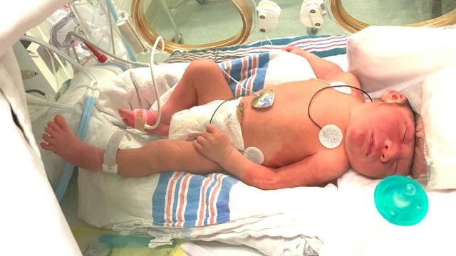 Baby born with ‘brain outside of skull' believed to be first to survive condition