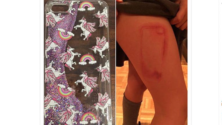 e5d9b186-Girl Burned By Leaking Cell Phone Cover-402970