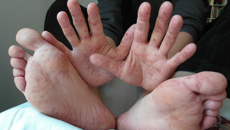 ee62df68-hand foot mouth_1476827767182-404023.jpg