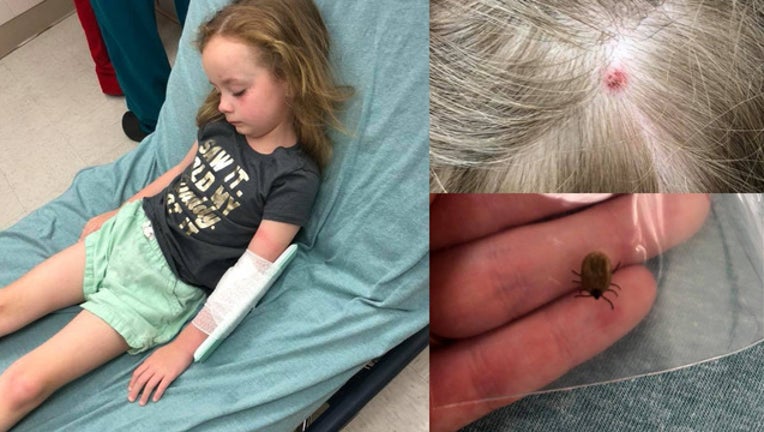 e33a11d6-storyful tick bite_1528656628850.jpg.jpg