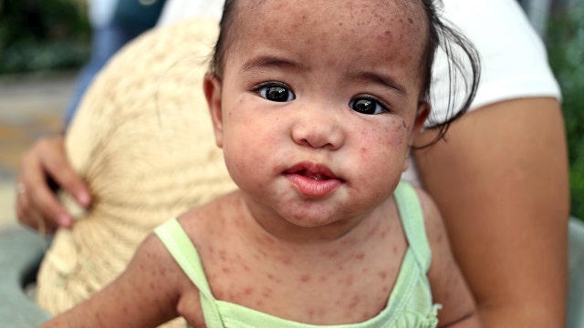 Measles wipes out the immune system’s ‘memory,’ making patients more vulnerable to other disease, study says