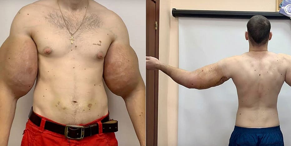 Russian 'Popeye' who injected triceps with OIL has life-saving surgery to  remove 'rotting' fake muscles