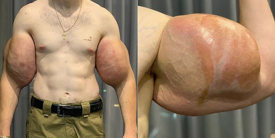 Russian 'Popeye' who injected triceps with OIL has life-saving surgery to  remove 'rotting' fake muscles