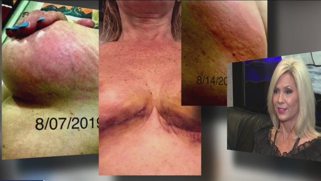 Houston woman says breast implants made her sick and she's not alone