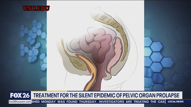 Treatment for the silent epidemic of pelvic organ prolapse