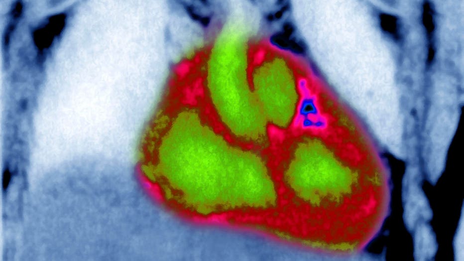 Heart, Mri