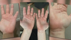 Houston-area woman believes cleaning chemical on shopping cart burned her hands