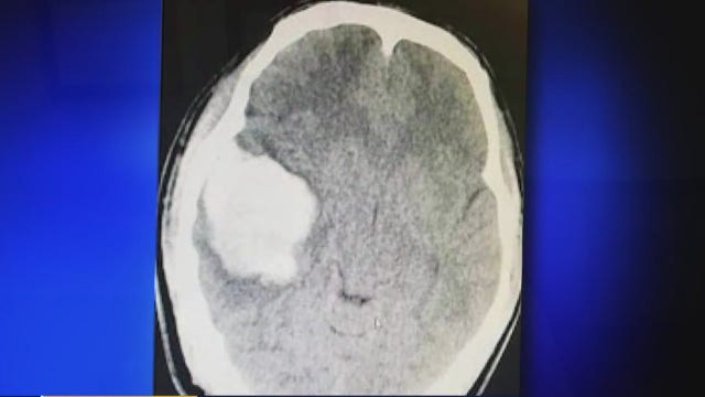 Houston 18-year-old survives rare and potentially fatal condition