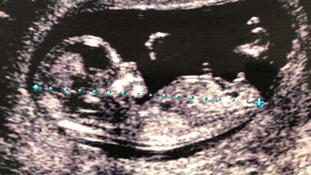 Tennessee bill would allow fathers to prevent abortions