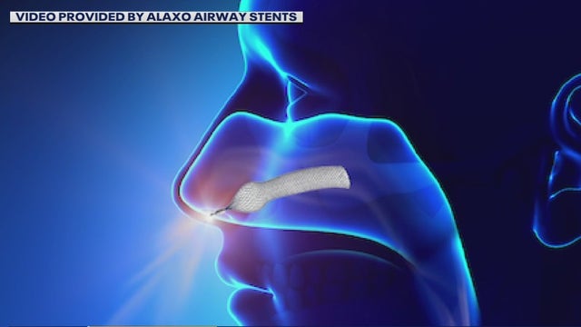 Nose stents to treat sleep apnea, snoring, and allergies