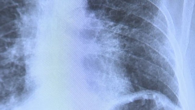 Doctor says all-natural treatment for COVID-19 shows promising results