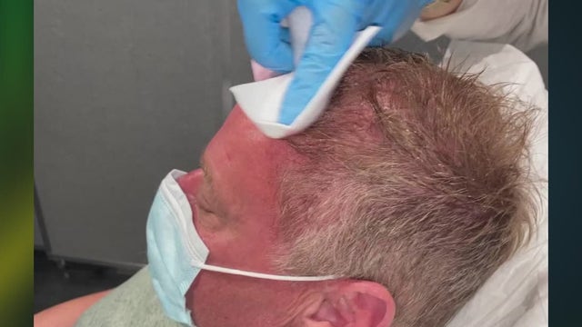 Treatment is stimulating hair loss after COVID-19