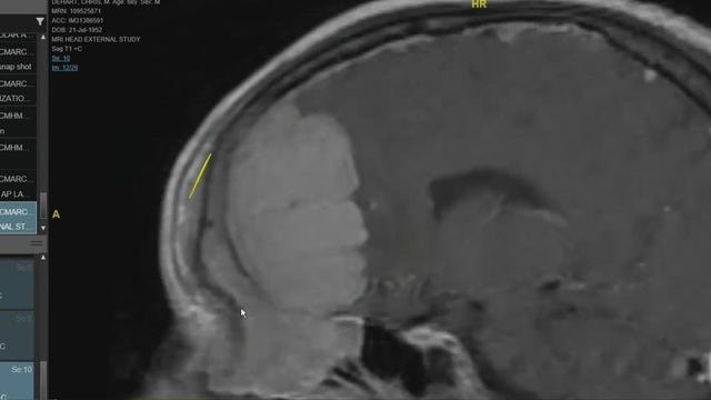 "Dream Team" at Houston Methodist Hospital saves man with gigantic brain tumor