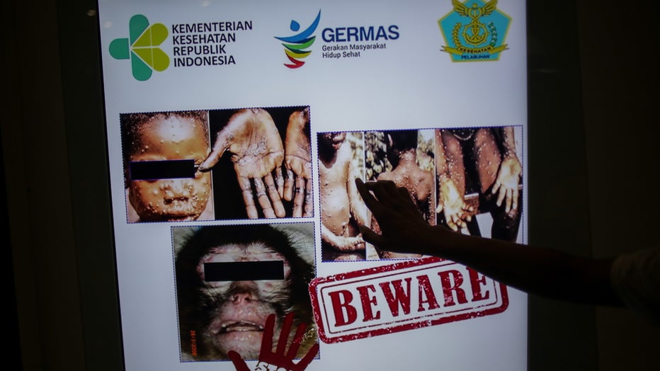monkey pox transmission monkey pox transmission