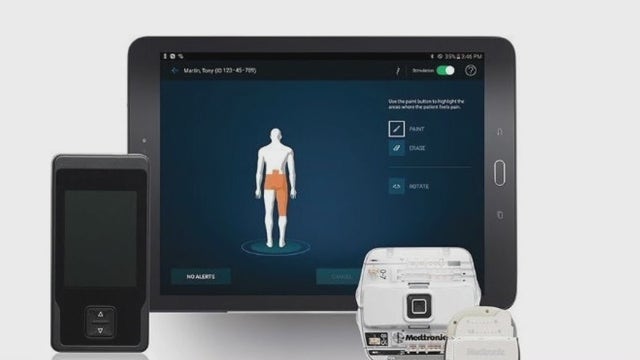 New state-of-the-art device stimulates spine to relieve back pain