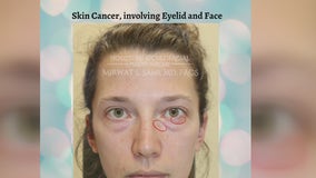 Woman shares skin cancer warning signs after undergoing extensive plastic surgery