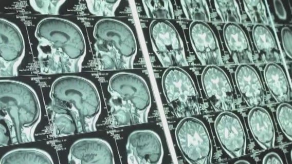 Stroke patients lose words from aphasia but get much needed help through Houston Aphasia Recovery Center