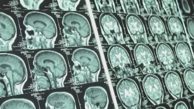 Stroke patients lose words from aphasia but get much needed help through Houston Aphasia Recovery Center