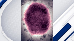 Monkeypox: What you should know as U.S. declares public health emergency