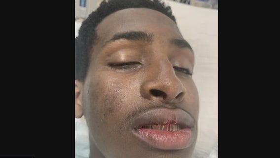 Teen cyclist's jaw broken after allegedly being punched riding through Midtown